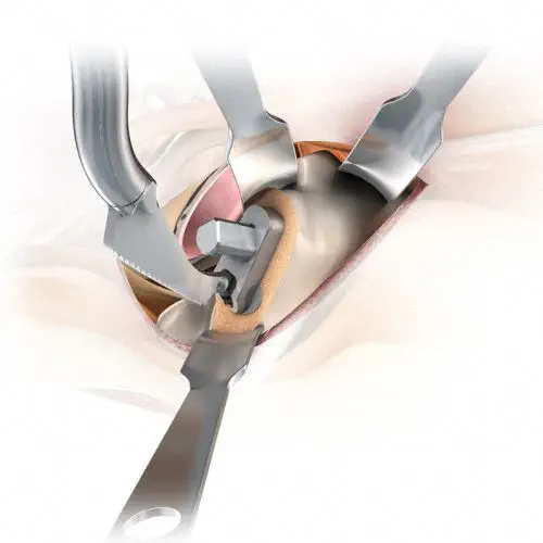 ชุดเครื่องมือผ่าตัดกระดูกสะโพก  Minimally invasive hip surgery instrument kit MIOS®  B. Braun