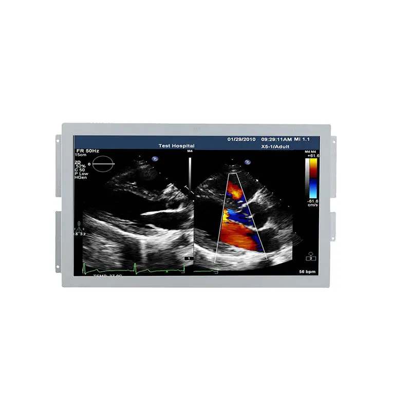 เครื่องตรวจอวัยวะภายในด้วยคลื่นเสียงความคมชัดสูง  Ultrasound imaging display U238W  Beacon